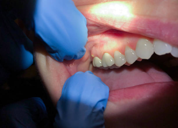 Best Emergency Tooth Extraction in Centreville, VA